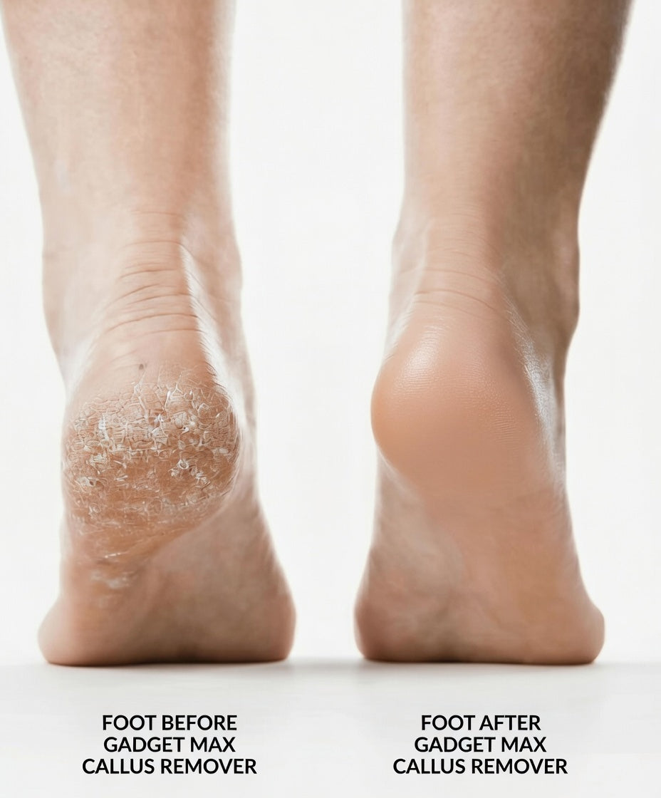 Callus Remover